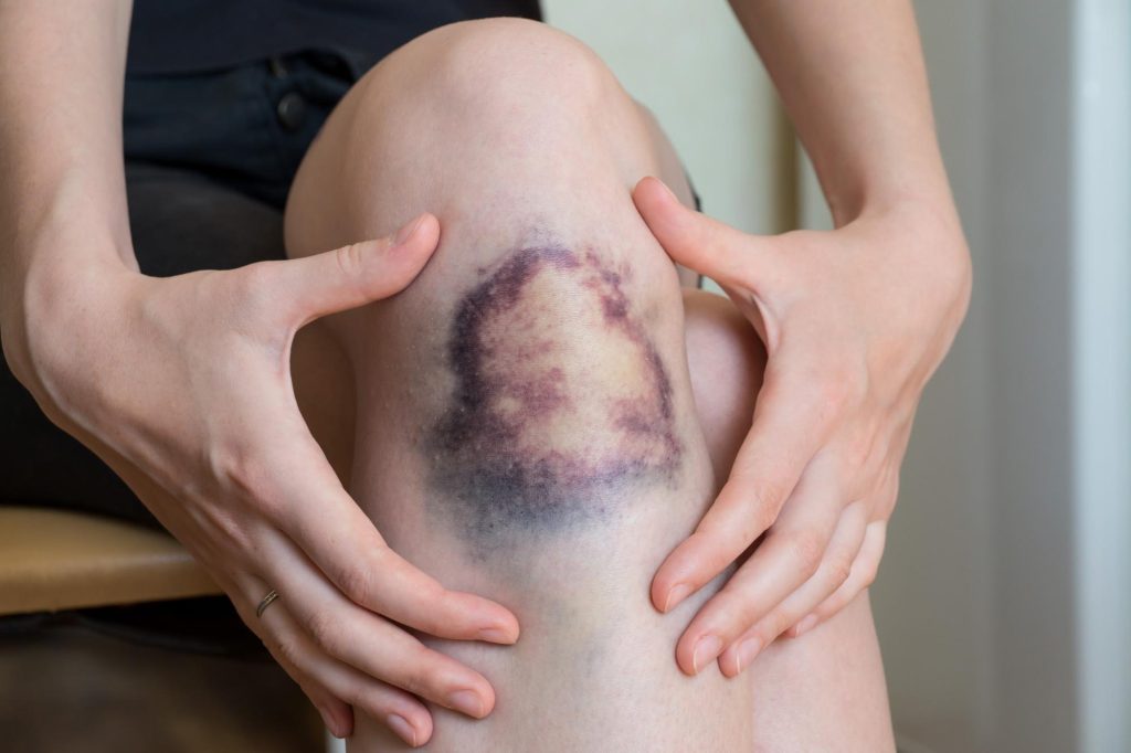 Large bruise covering knee of woman, while she frames the bruise with her hands.