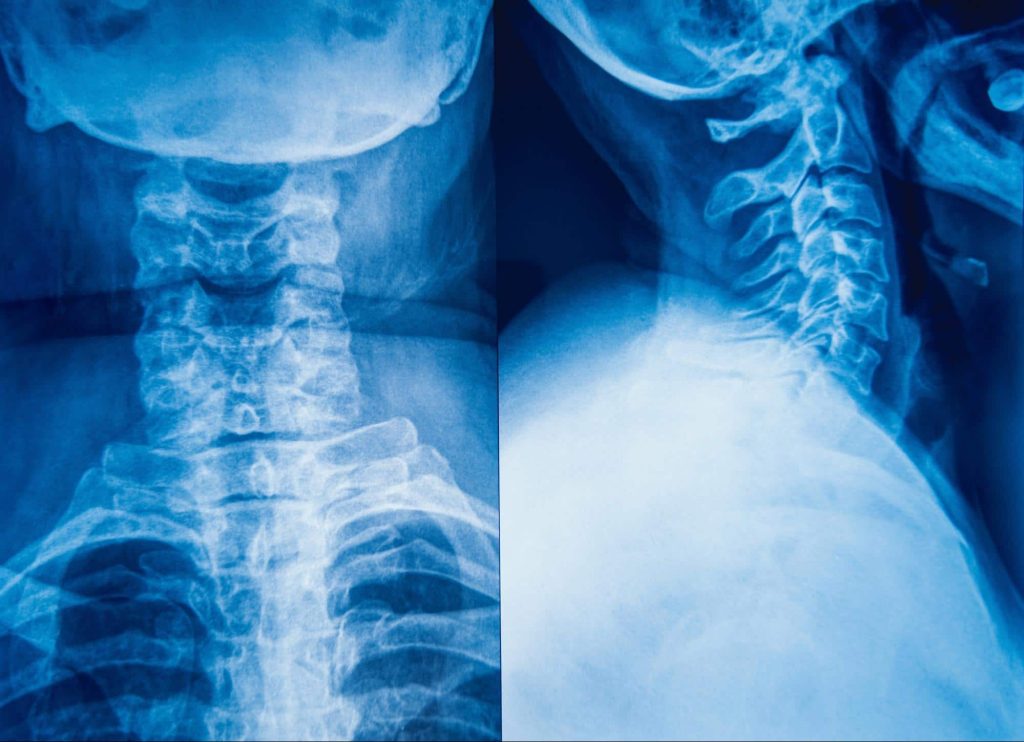 X-rays of neck from front and side showing soft tissue damage.