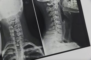 X-ray of neck injury after a car accident