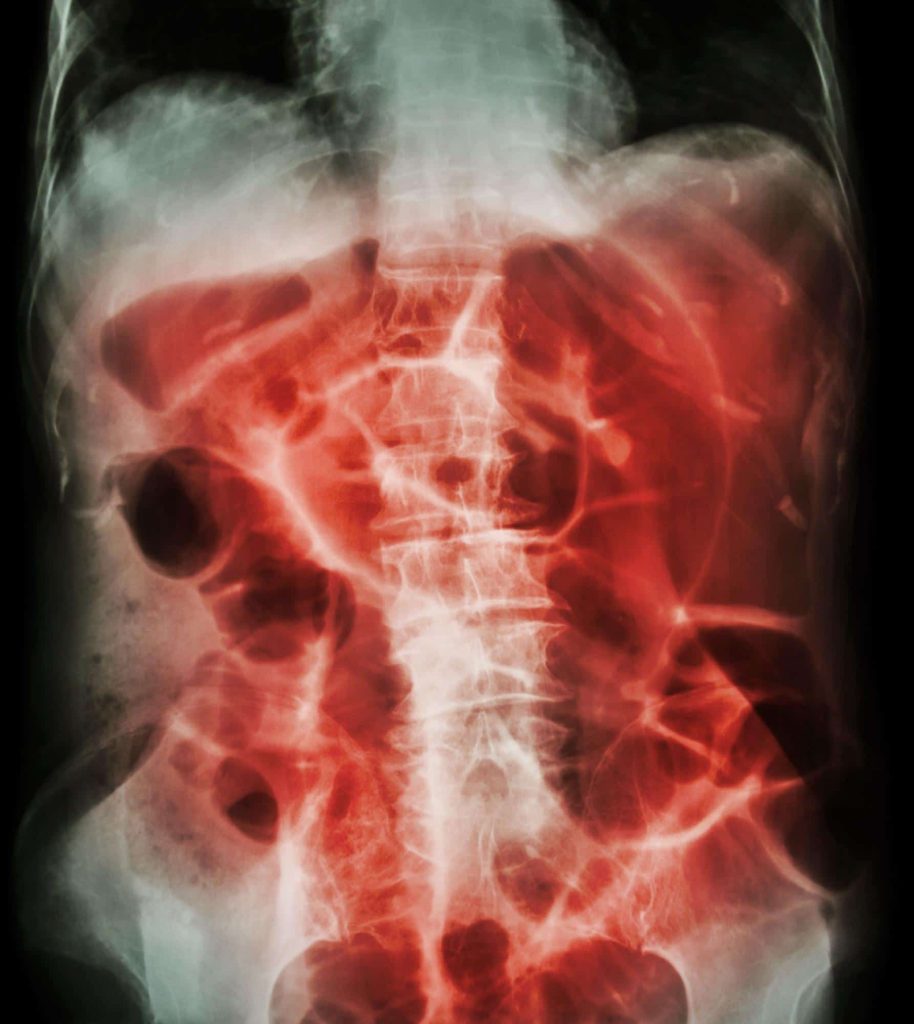X-ray of human torso with stomach highlighted red