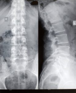 X ray of spine