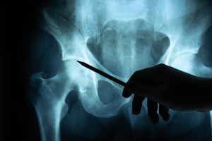 Doctor examining x ray of hip.
